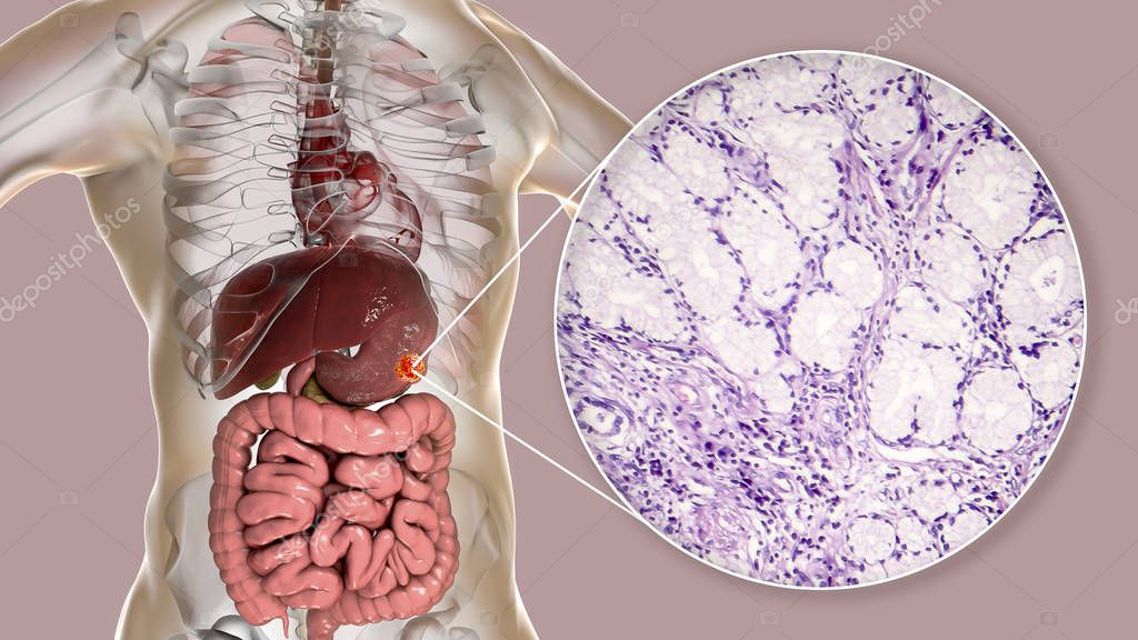 Mucinous adenocarcinoma of stomach, illustration and micrograph