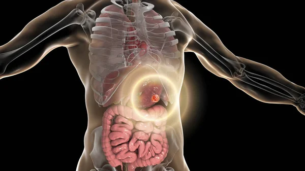 Stomach cancer, gastric carcinoma, illustration — Stock Photo, Image