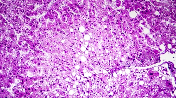 Histopatologi hati steatosis, atau hati berlemak — Stok Foto