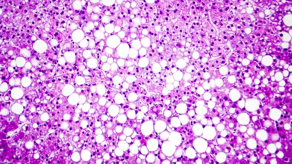 stock image Histopathology of liver steatosis, or fatty liver