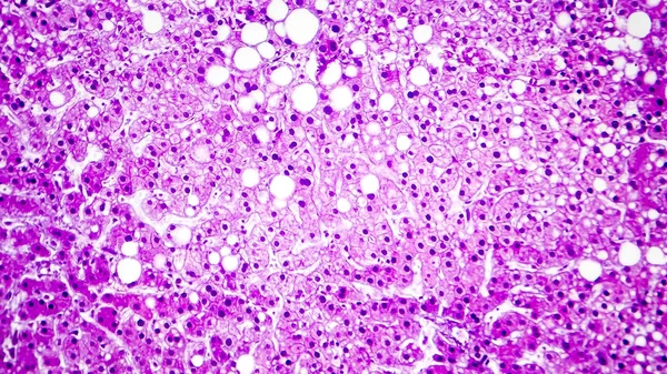 Histopatologia da esteatose hepática, ou fígado gordo — Fotografia de Stock