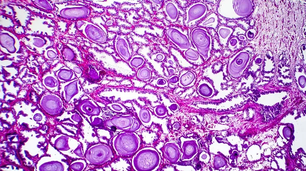 Prostat bezi hiperplazisinin histopatolojisi — Stok fotoğraf