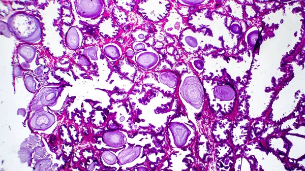 Istopatologia dell'iperplasia della ghiandola prostatica — Foto Stock