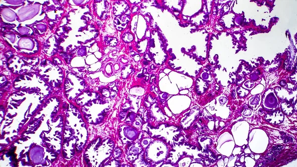 Histopatología de la hiperplasia de la próstata —  Fotos de Stock