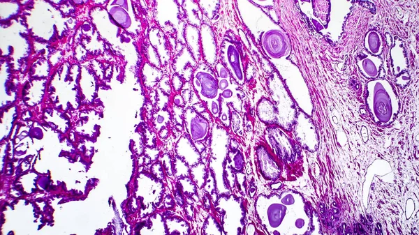 Гистопатология гиперплазии предстательной железы — стоковое фото