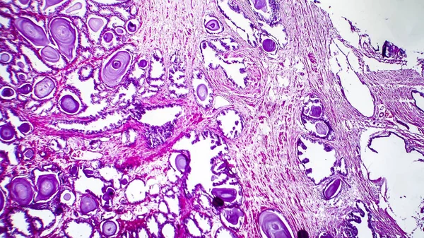 Histopatología de la hiperplasia de la próstata —  Fotos de Stock