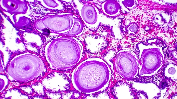 Histopatología de la hiperplasia de la próstata — Foto de Stock