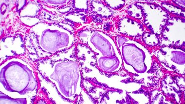 Prostat bezi hiperplazisinin histopatolojisi