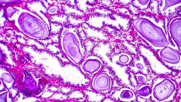 前列腺增生组织病理学 — 图库照片