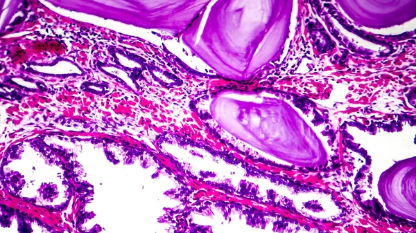 前列腺增生组织病理学 — 图库照片