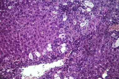 Viral hepatit, ışık mikrografı