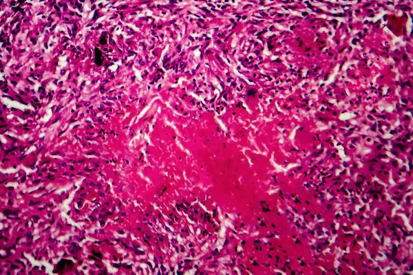 Tubercolosi ausiliaria, micrografo leggero — Foto Stock