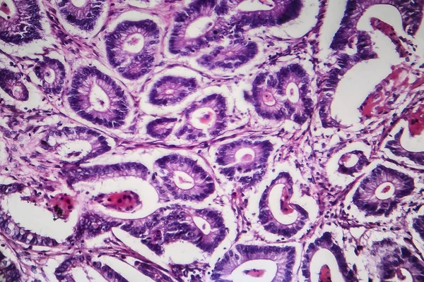 Colon cancer, light micrograph