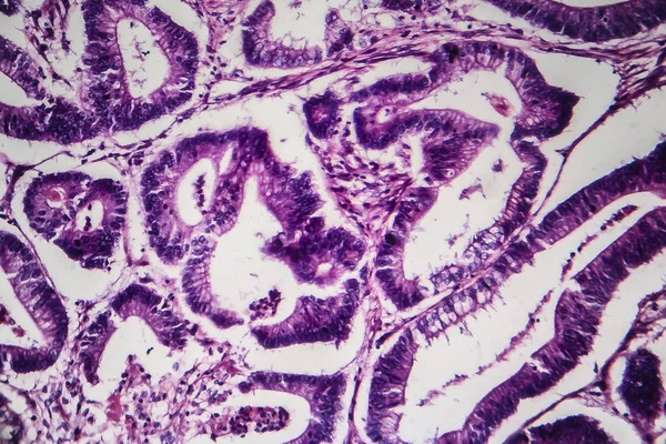 Рак товстої кишки, легкий мікрограф — стокове фото