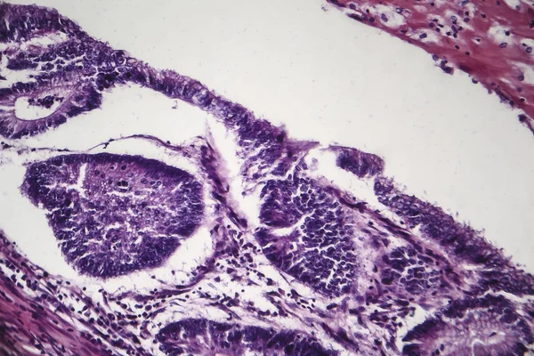 Cancro do cólon, micrografia de luz — Fotografia de Stock