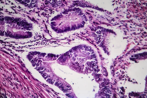 Cancro al colon, micrografo leggero — Foto Stock