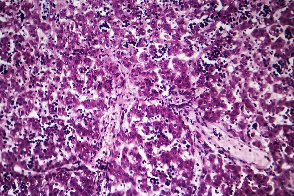 Хронический активный гепатит, световой микрограф — стоковое фото
