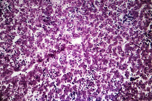Hepatitis crónica activa, micrografía ligera — Foto de Stock