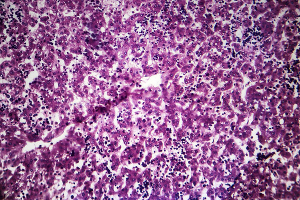 Chronic active hepatitis, light micrograph