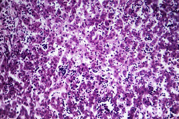 Chronic active hepatitis, light micrograph