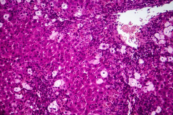 Hepatite viral, micrografia de luz — Fotografia de Stock