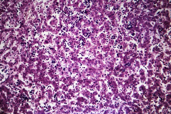 Хронический активный гепатит, световой микрограф — стоковое фото