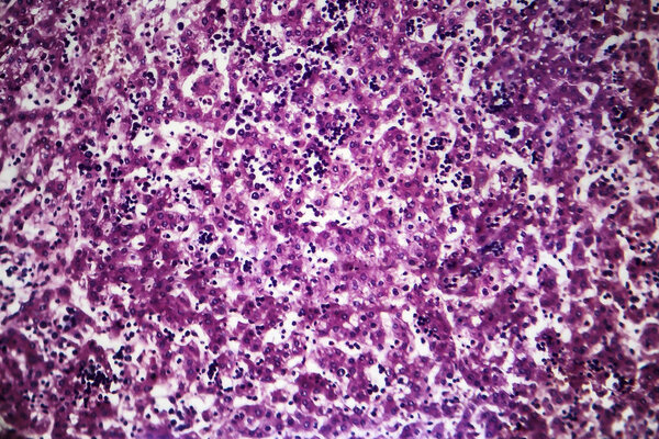 Chronic active hepatitis, light micrograph