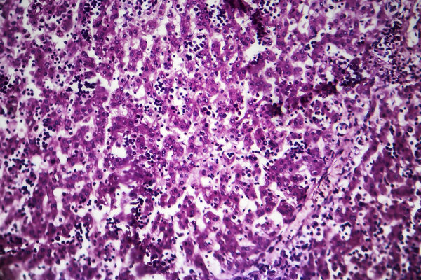 Chronic active hepatitis, light micrograph