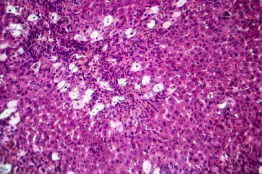 Viral hepatit, ışık mikrografı