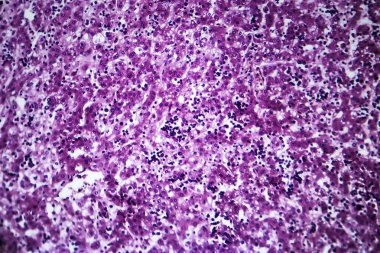 Kronik aktif hepatit, hafif mikrograf