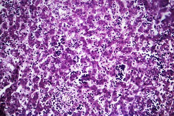 Chronic active hepatitis, light micrograph