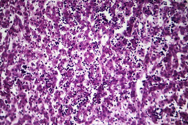 Chronic active hepatitis, light micrograph