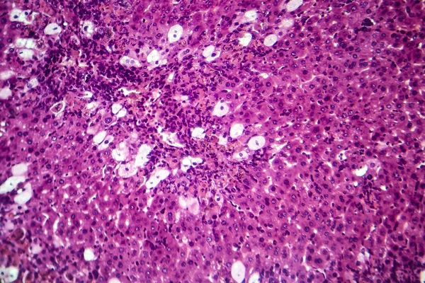 바이러스성 간염, 가벼운 현미경 사진 — 스톡 사진
