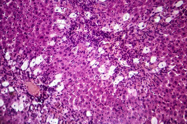 바이러스성 간염, 가벼운 현미경 사진 — 스톡 사진