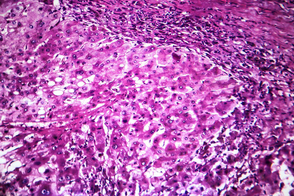 Alcoholic hepatitis, light micrograph