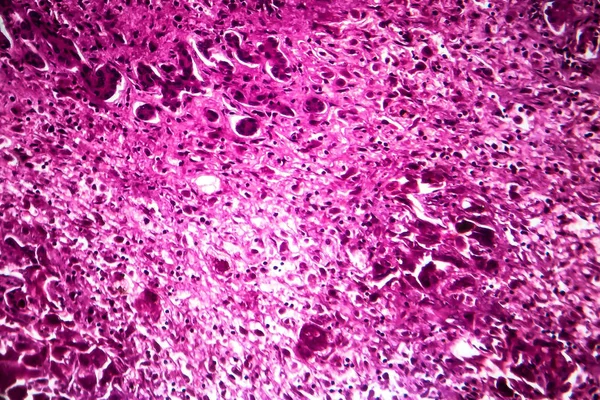 Altakut şiddetli hepatit, hafif mikrograf — Stok fotoğraf