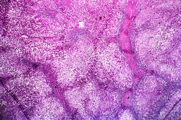 알콜 성 간염, 가벼운 현미경 사진 — 스톡 사진