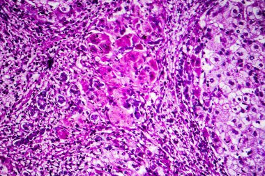 Geçit sirozu hipopatolojisi