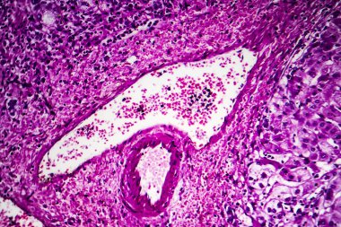 Geçit sirozu hipopatolojisi