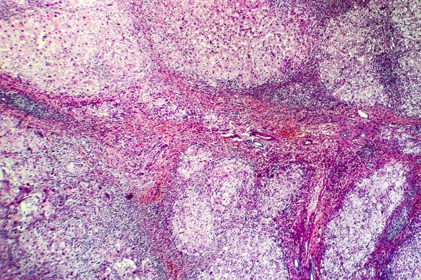 Historia de la cirrosis portal — Foto de Stock