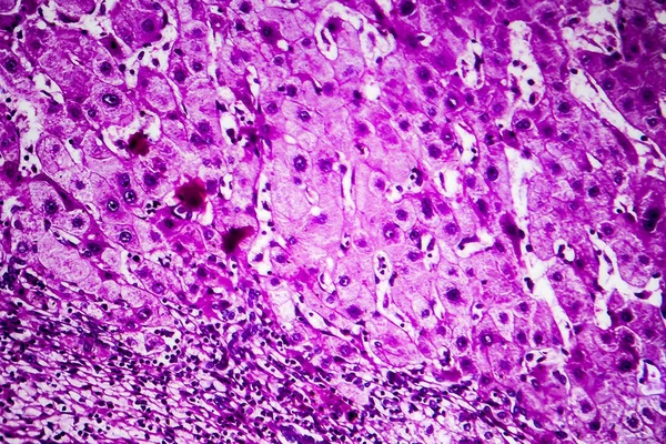 Histopatologia da cirrose portal — Fotografia de Stock