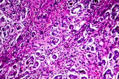 Safra kesesi sirozu hipopatolojisi