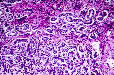 Safra kesesi sirozu hipopatolojisi