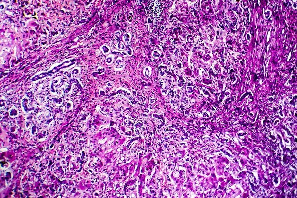 Histopatologie biliární cirhózy — Stock fotografie