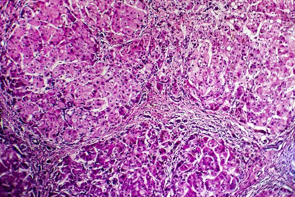 Histopatologi dari sirosis biliari — Stok Foto