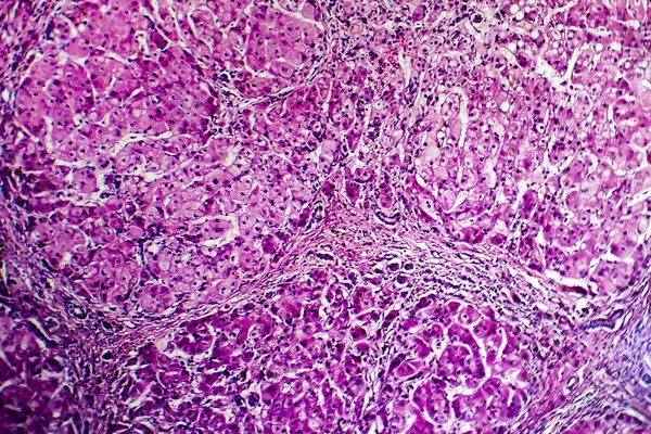 胆汁性肝硬変の組織病理 — ストック写真