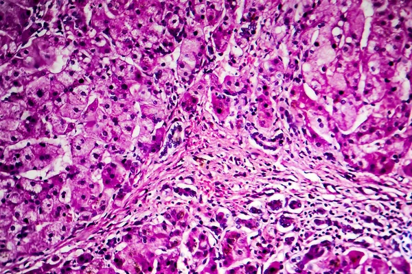 Histopatologia da cirrose biliar — Fotografia de Stock
