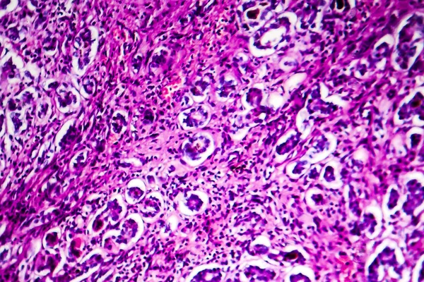 Histopathology of biliary cirrhosis — Stock Photo, Image