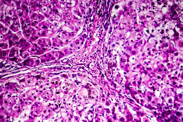 Histopathology of biliary cirrhosis — Stock Photo, Image