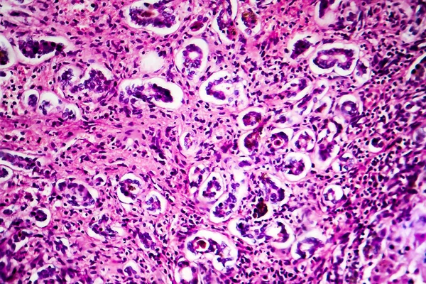 Histopathology of biliary cirrhosis — Stock Photo, Image
